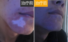 男性白癜风如何做能治好呢