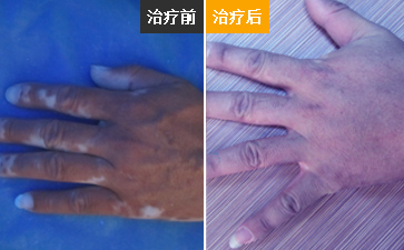 白癜风怎么治能好