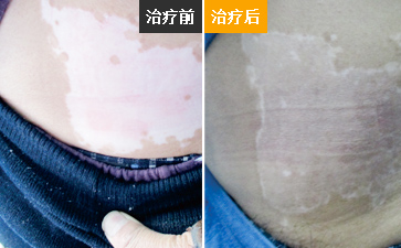 白癜风照uvb破皮是怎么回事