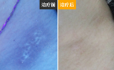 白癜风发展比较快怎么办