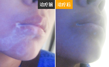 白癜风擦药变黑就意味着康复吗