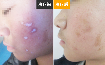 白癜风发展期怎么治效果好呢
